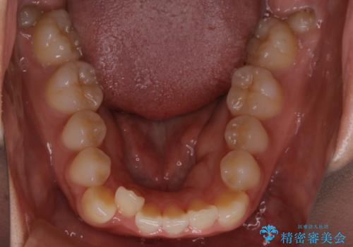 インビザライン矯正 短期間でがたつきのない歯並びに!の治療前