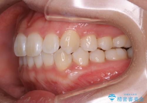インビザライン矯正 短期間でがたつきのない歯並びに!の治療後