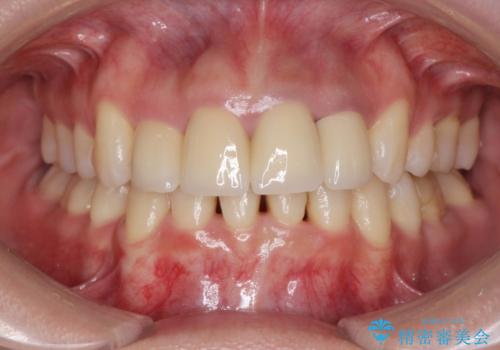 変色した歯を改善、セラミック治療の治療後