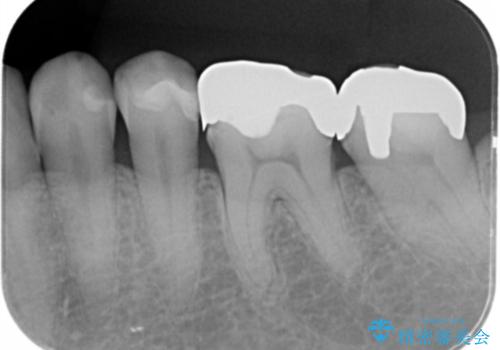 銀歯をセラミック治療で白くの治療前