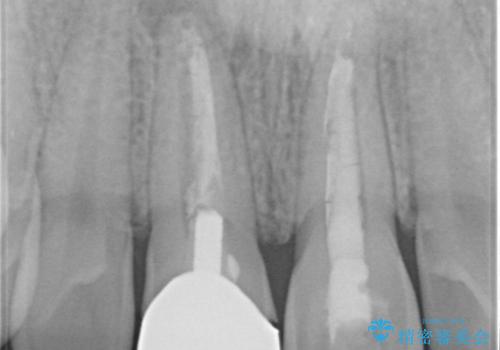 前歯の変色 神経のない歯の再治療の治療前