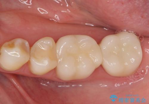 銀歯をセラミック治療で白くの治療後