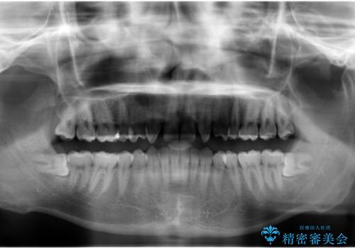 前歯のすきま 生まれつき歯が少ないのを治療の治療前