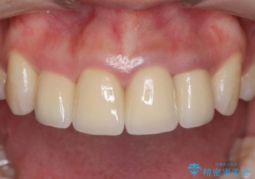 変色した歯を改善、セラミック治療の治療後
