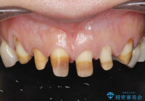 [ テトラサイクリン歯 ] 長年気になっていた変色歯を改善の治療中