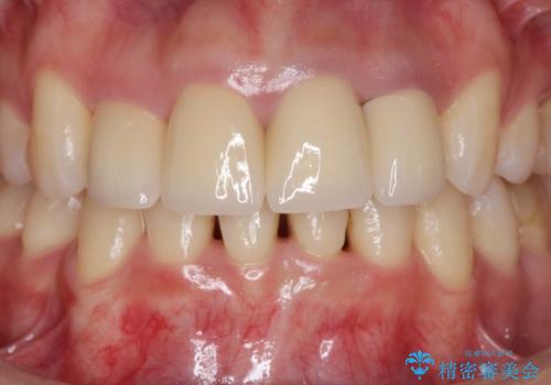 変色した歯を改善、セラミック治療の治療後