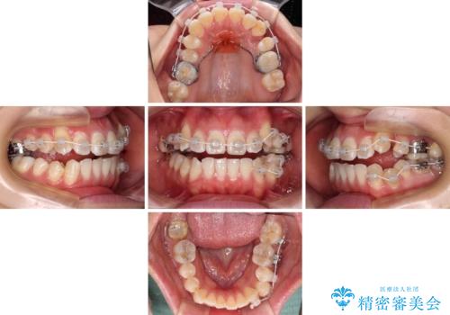 八重歯と開咬の抜歯矯正 ワイヤー装置を併用したインビザライン矯正治療の治療中