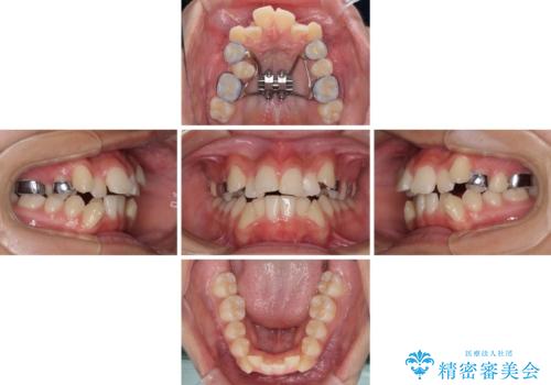 上顎骨幅が狭い 急速拡大装置を併用した抜歯矯正の治療中
