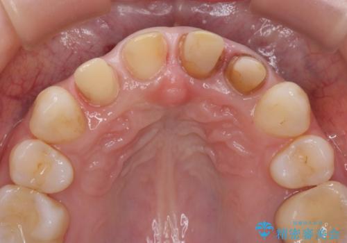 変色した歯を改善、セラミック治療の治療中