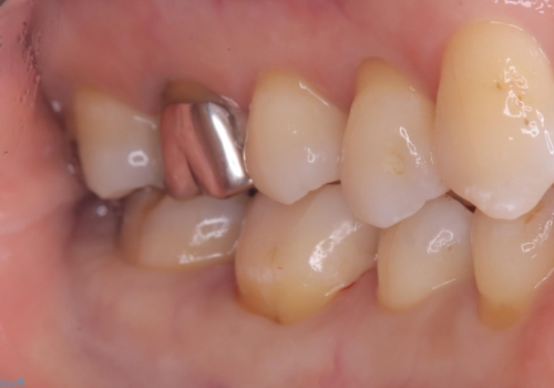 【セラミックインレー】歯と歯の間に物がよく詰まるの治療後