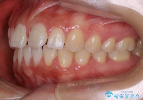 インビザライン矯正 前歯のすきっ歯を治したいの治療前