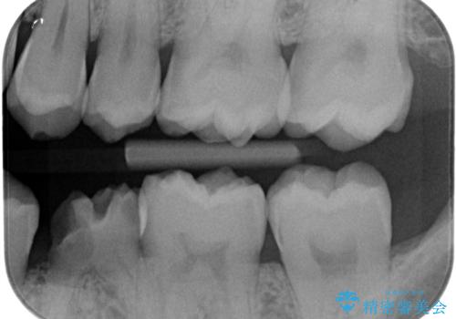 奥歯の虫歯 セラミックインレーでの修復処置の治療前