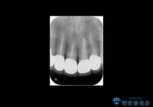 前歯のセラミック 神経の再治療からの治療後