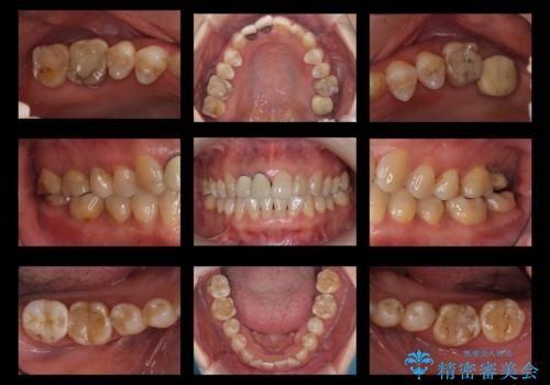 全体的な虫歯治療 他院で入れたインプラントの続きもの治療前
