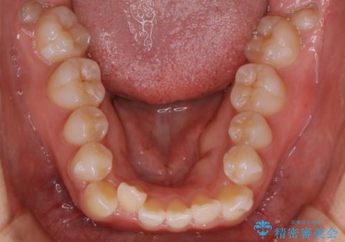インビザライン矯正 短期間でがたつきのない歯並びに!の治療中