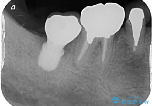 毎食後物がつまる! インプラント治療の治療後