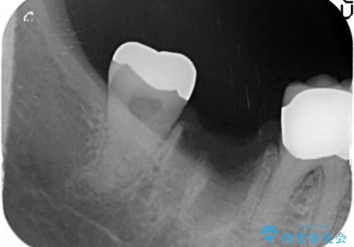 60代女性 奥歯のインプラント の治療前