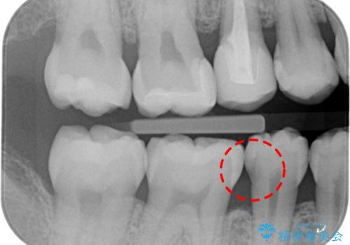歯と歯の間の虫歯　セラミックインレーでの修復処置