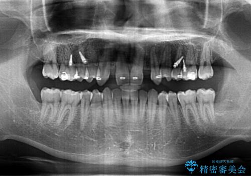 前歯のすきま　生まれつき歯が少ないのを治療の治療中