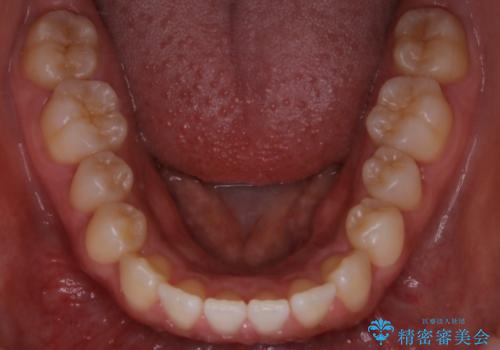 インビザライン矯正　前歯のすきっ歯を治したいの治療前