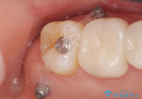 伸びてしまった奥歯、咬合平面を揃えたインプラント治療の治療中