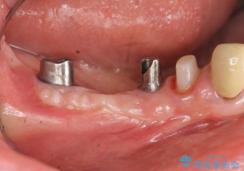 狭小な歯槽骨に対するインプラント治療の治療中