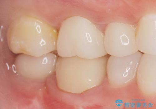 伸びてしまった奥歯、咬合平面を揃えたインプラント治療の治療後