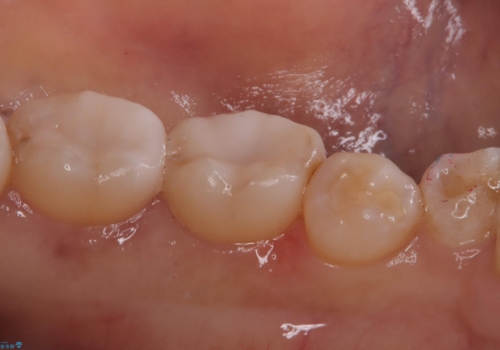 【セラミックインレー】詰め物が外れた 白くしたいの治療後