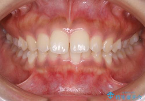 インビザライン矯正 歯を抜かずに出っ歯を改善!の治療中