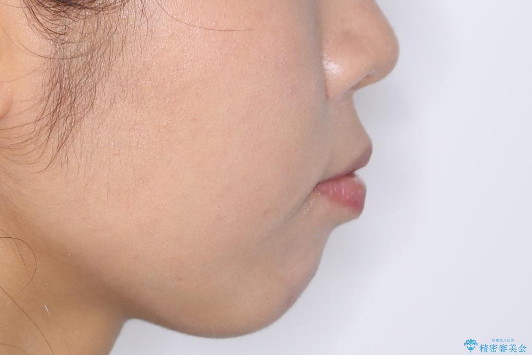 インビザライン矯正 歯を抜かずに出っ歯を改善!の治療前(顔貌)