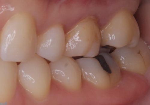 詰め物と歯の境目に汚れが溜まるの治療後