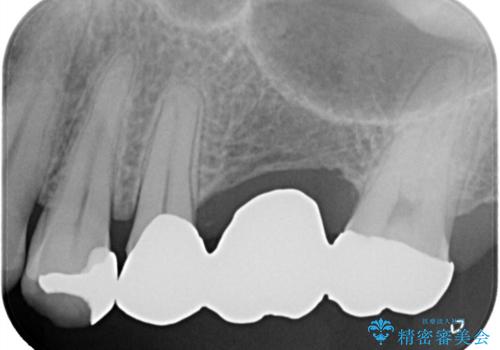 【セラミッククラウン】【ブリッジ】奥歯の奥側からよく汚れが出てくるの治療前