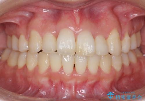 難症例　奥歯がかみ合っていない　歯並び矯正で別人にの症例 治療後