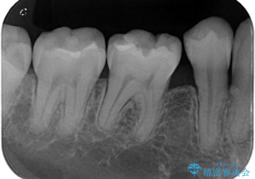 【セラミックインレー】プラスチックの詰め物をセラミックにしたいの治療前