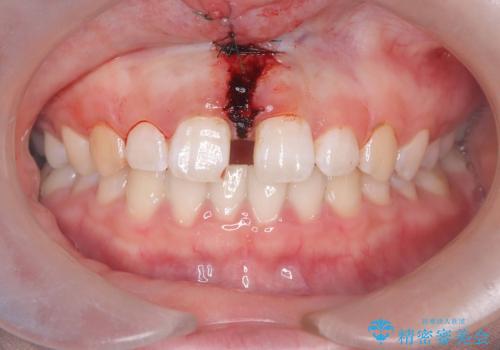 【上唇小帯切除術】子どもの頃から上の前歯の歯茎が気になってた!の治療中