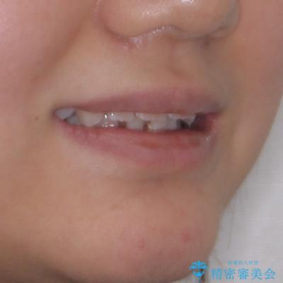 前歯が2本ない ワイヤー装置での抜歯矯正の治療前(顔貌)