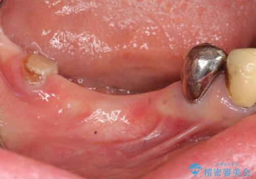 狭小な歯槽骨に対するインプラント治療の症例 治療前