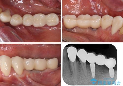 入れ歯を使いたくない 細い骨にインプラントを埋入した補綴治療の治療後
