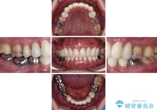 黄ばんだ前歯をきれいに 前歯の審美歯科治療の治療後