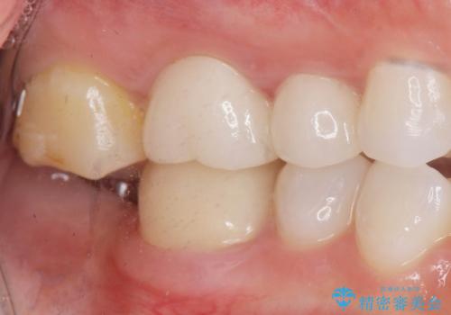 伸びてしまった奥歯、咬合平面を揃えたインプラント治療の治療前