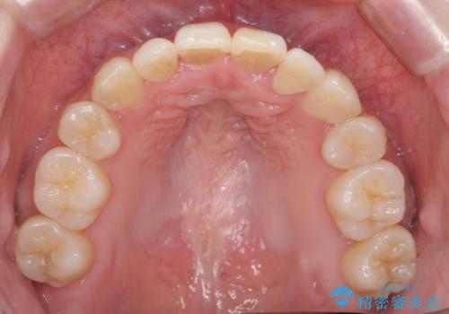 難症例　奥歯がかみ合っていない　歯並び矯正で別人にの治療後