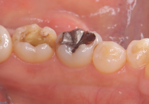 【セラミックインレー】詰め物が外れた 白くしたいの治療前