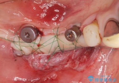 狭小な歯槽骨に対するインプラント治療の治療前