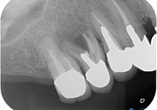 奥歯で咬むと痛いの治療前