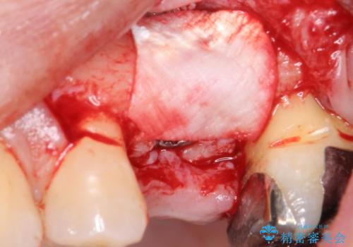 歯茎が腫れる　インプラントでの治療の治療後