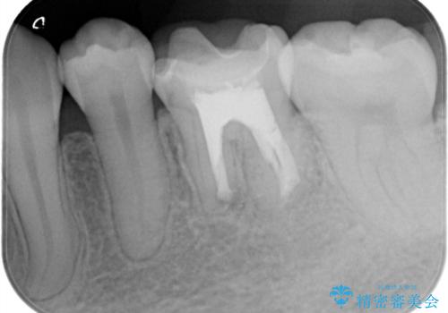 【歯根端切除術】根っこの先端の病気が治らないの治療後