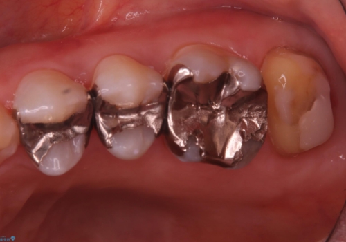 詰め物と歯の境目に穴が空いているの治療中