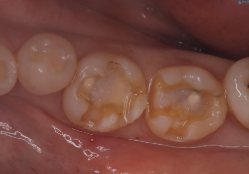 【セラミックインレー】詰め物が外れた 白くしたいの治療中