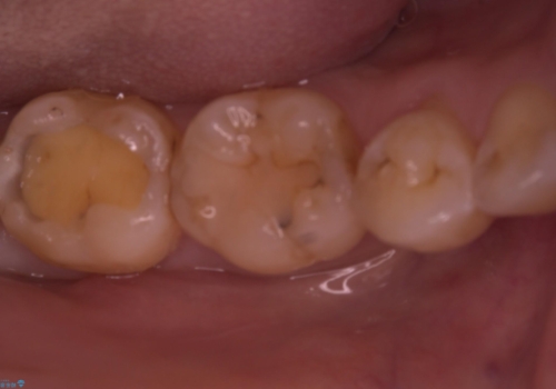 【セラミックインレー】プラスチックの詰め物をセラミックにしたいの治療中