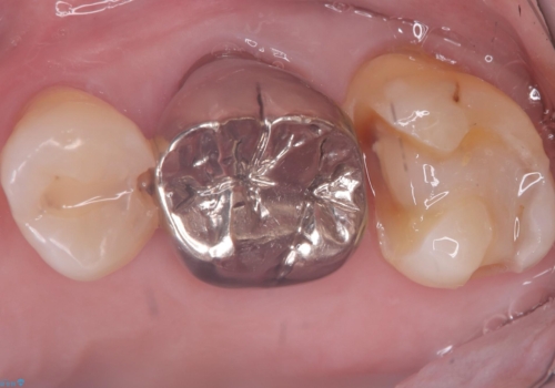 フロス通したら詰め物が取れたの治療中